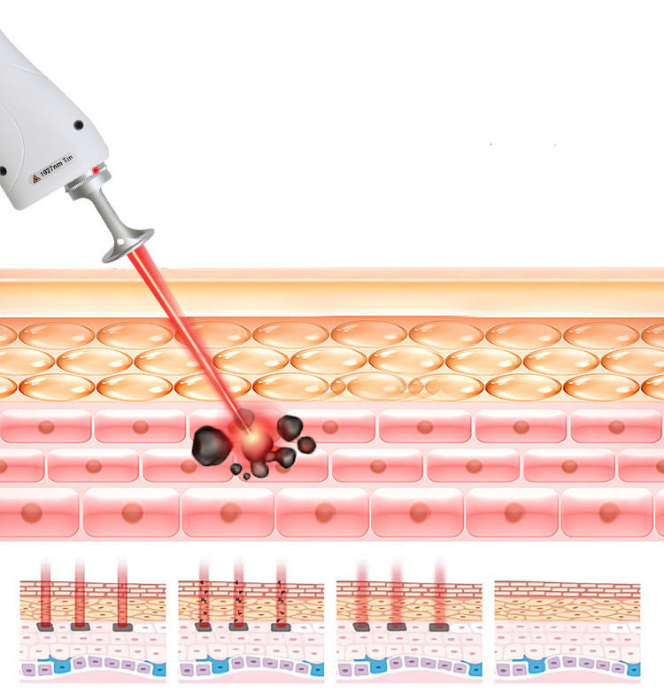 ba-fc24 thulium laser machine principle