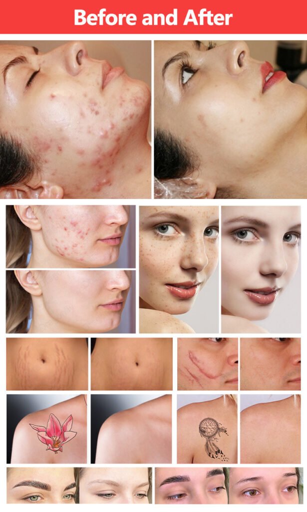 fractional co2 picolaser before after