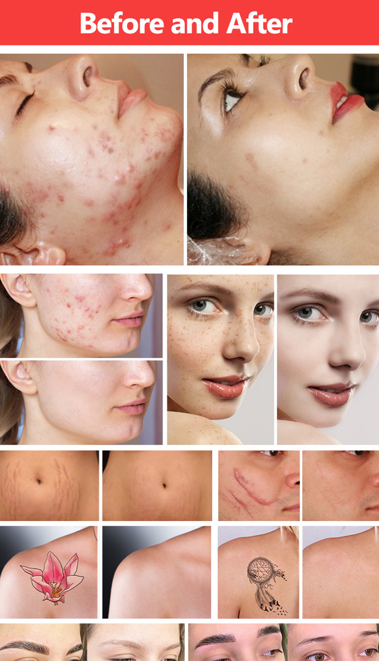 fractional co2 laser picolaser machine