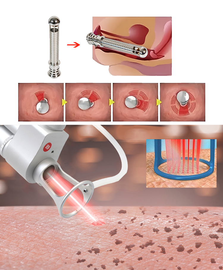fractional co2 laser