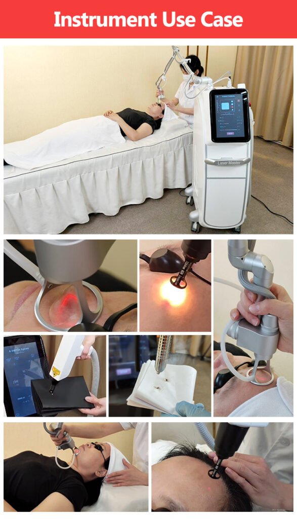 picolaser fractional co2