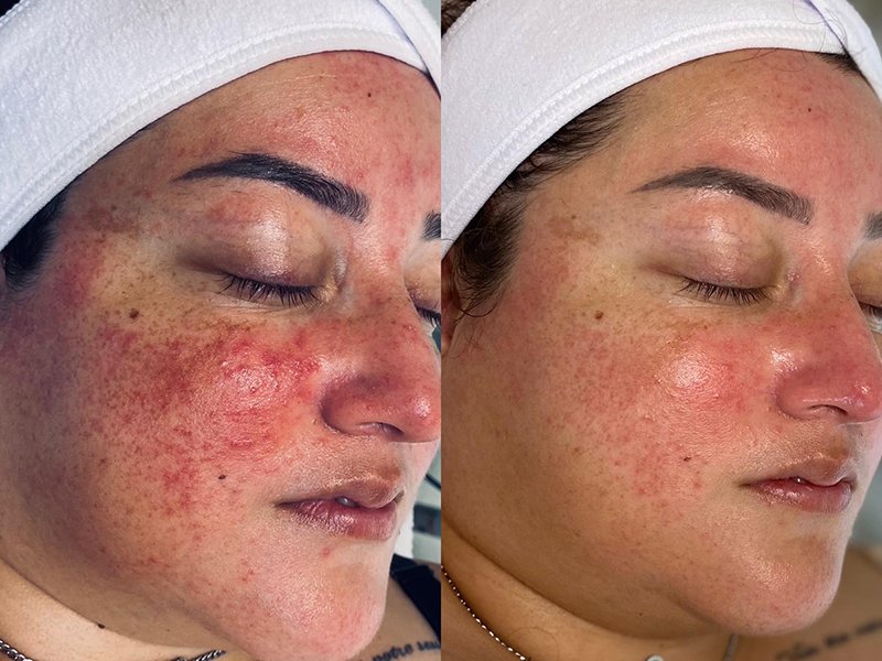 980nm face before after