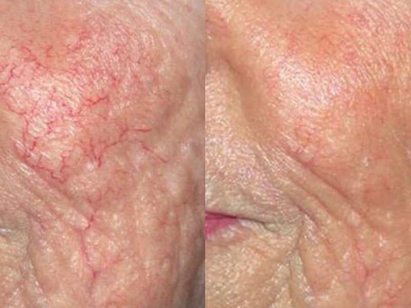980nm face red blood before after