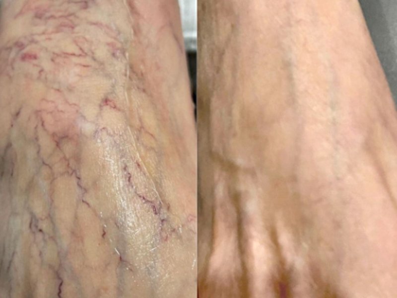 980nm foot before after