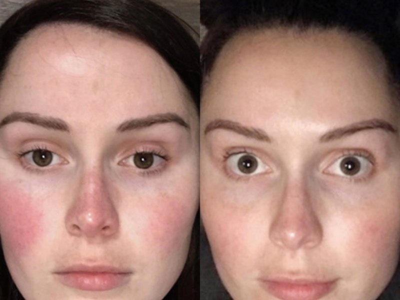 980nm laser before after