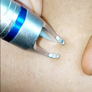 980nm laser blood vessel removal