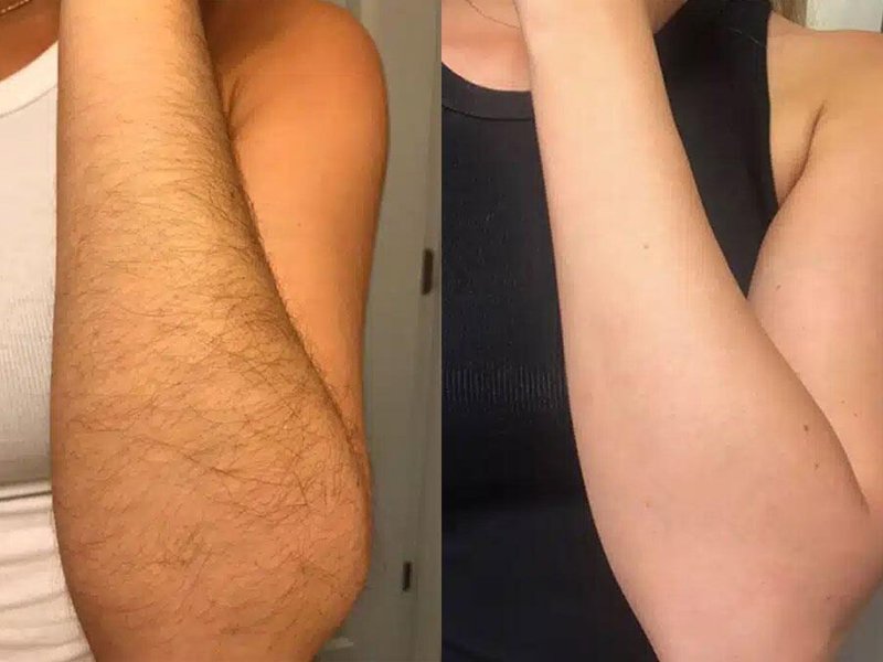 soprano titanium laser arm hair removal before after