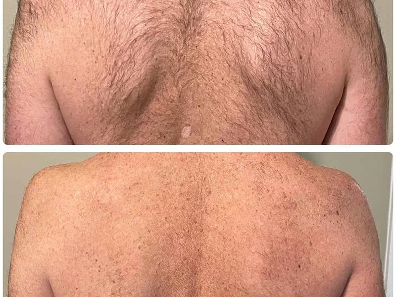 back laser hair removal