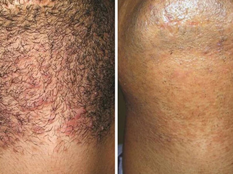 soprano titanium laser beard hair removal before after