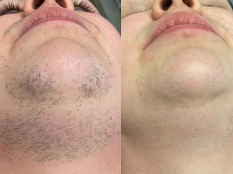 beard laser hair removal