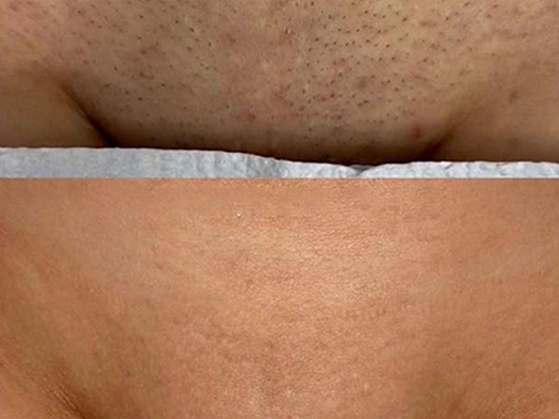 bikini line laser hair removal
