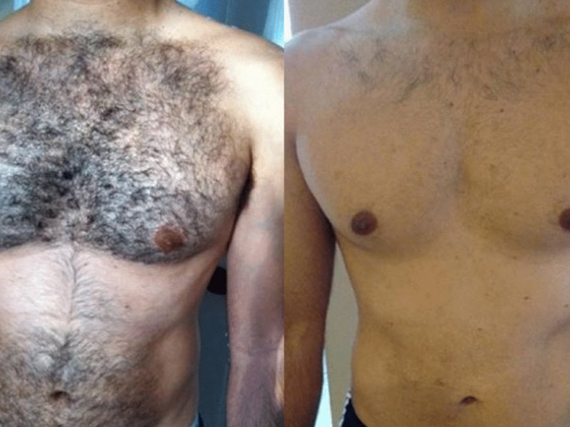 soprano titanium laser chest hair removal before after
