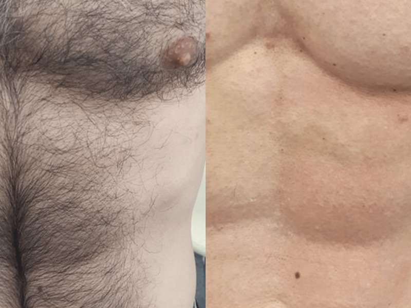 chest laser hair removal machine