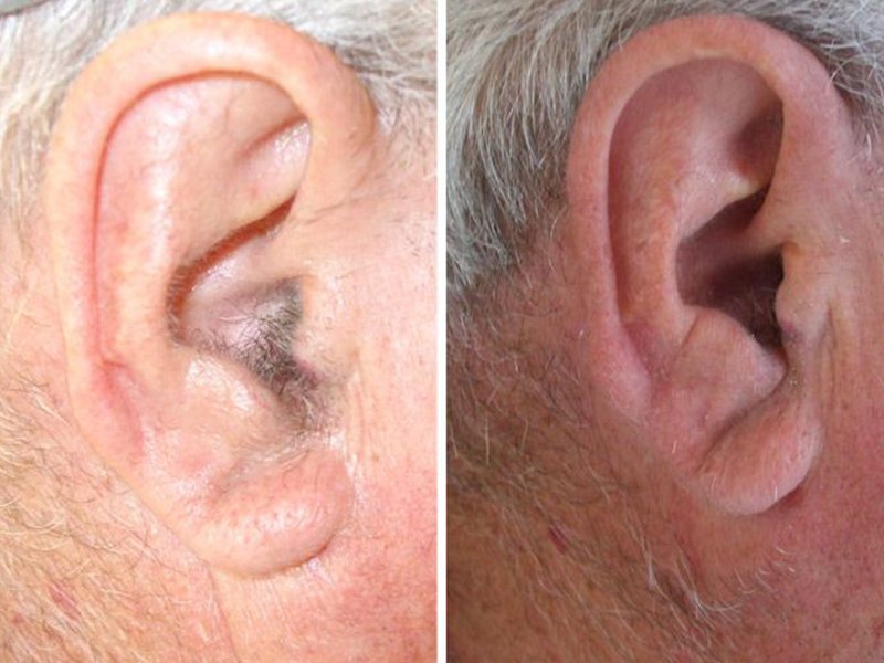 ears laser hair removal