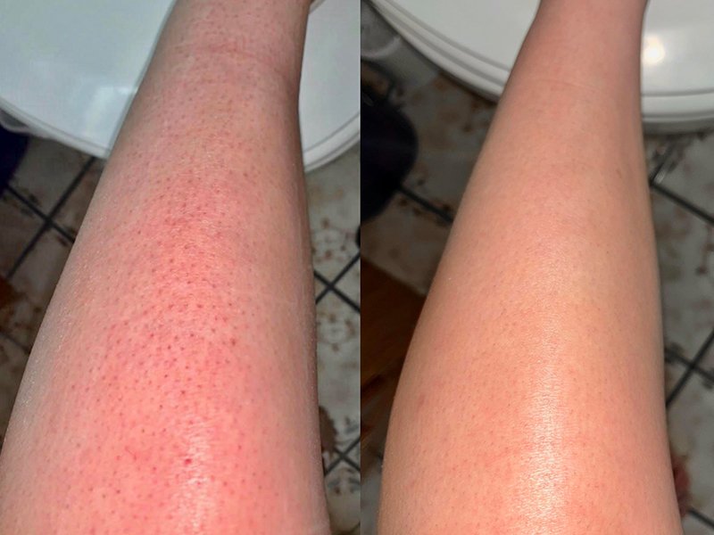 leg laser hair removal