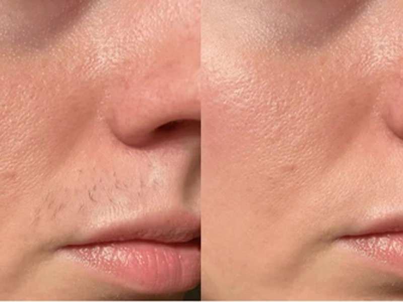 soprano titanium laser lip hair removal