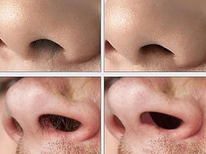 nose hair removal