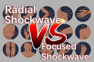 radial shockwave vs focused shockwave