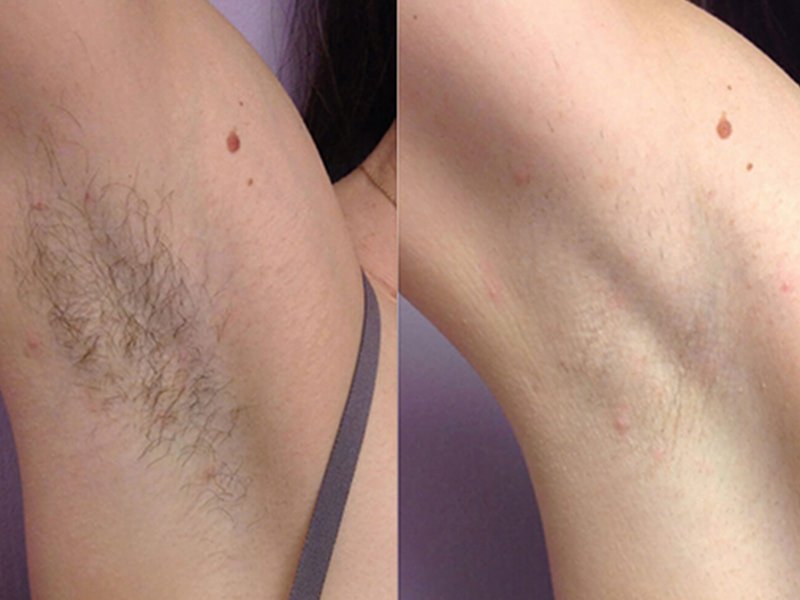 underarm laser hair removal machine