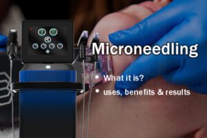 microneedling: what it is, uses, benefits & results