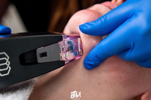 microneedling machine for clinics