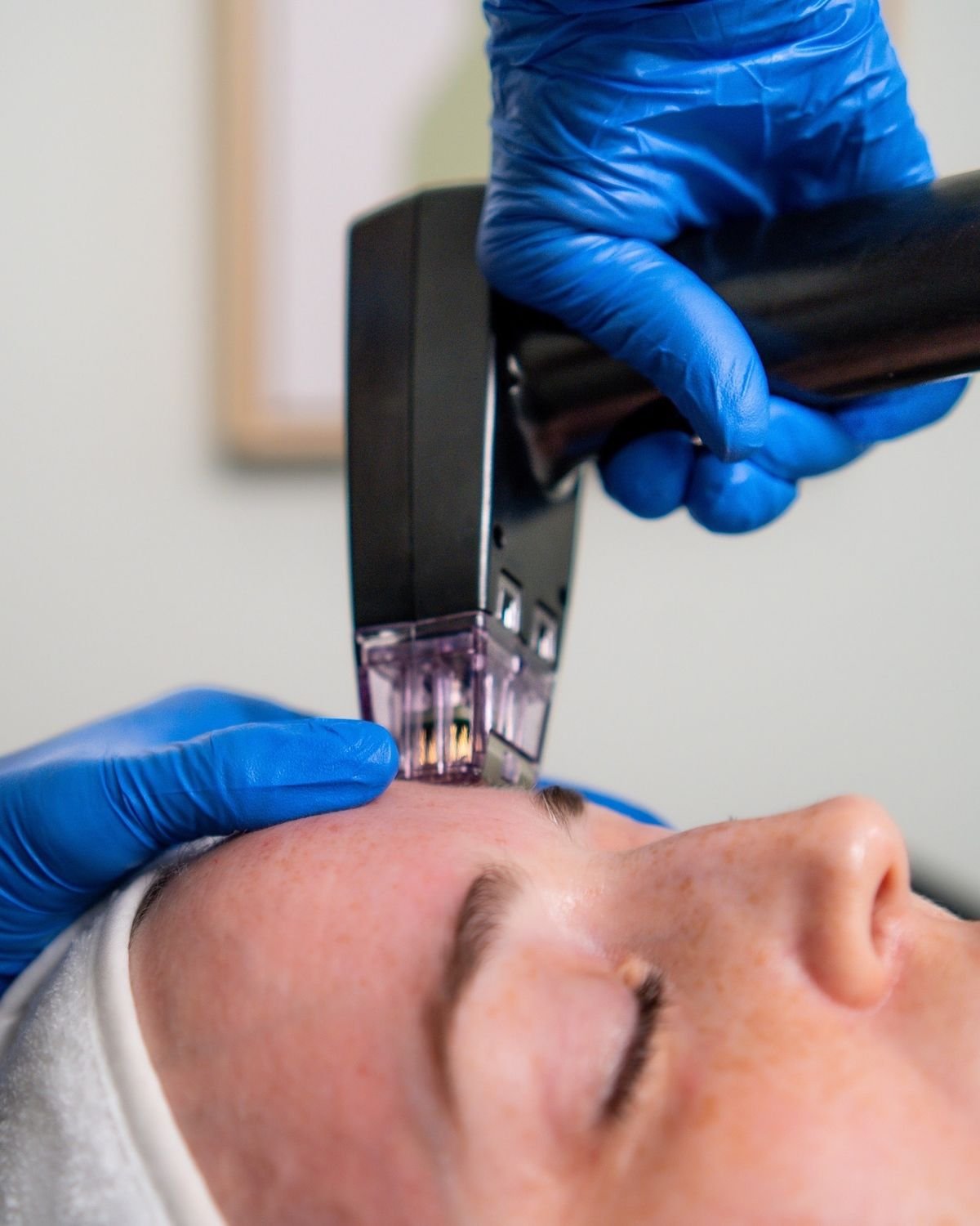 Comparison between traditional microneedling pen and professional RF microneedling machine results