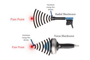 Radial vs Focused Shockwave