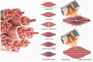 bamboolaser focused shockwave machine principle