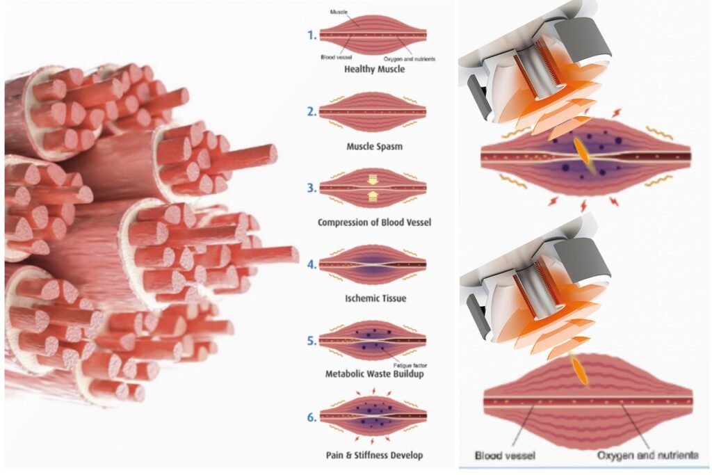 bamboolaser focused shockwave machine principle