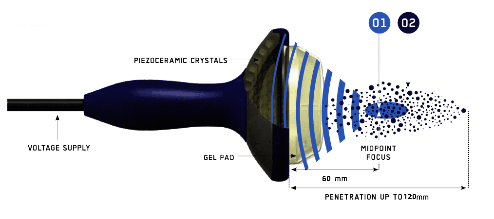 focused shockwave machine working handle
