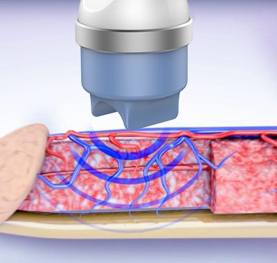 focused shockwave therapy machine