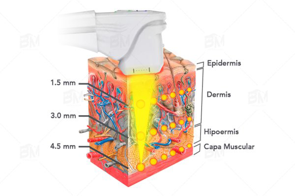 ba-hf36 hifu machine principle