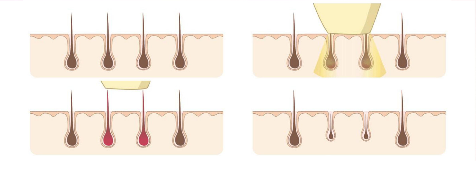 ba-mf27 laser hair removal principle