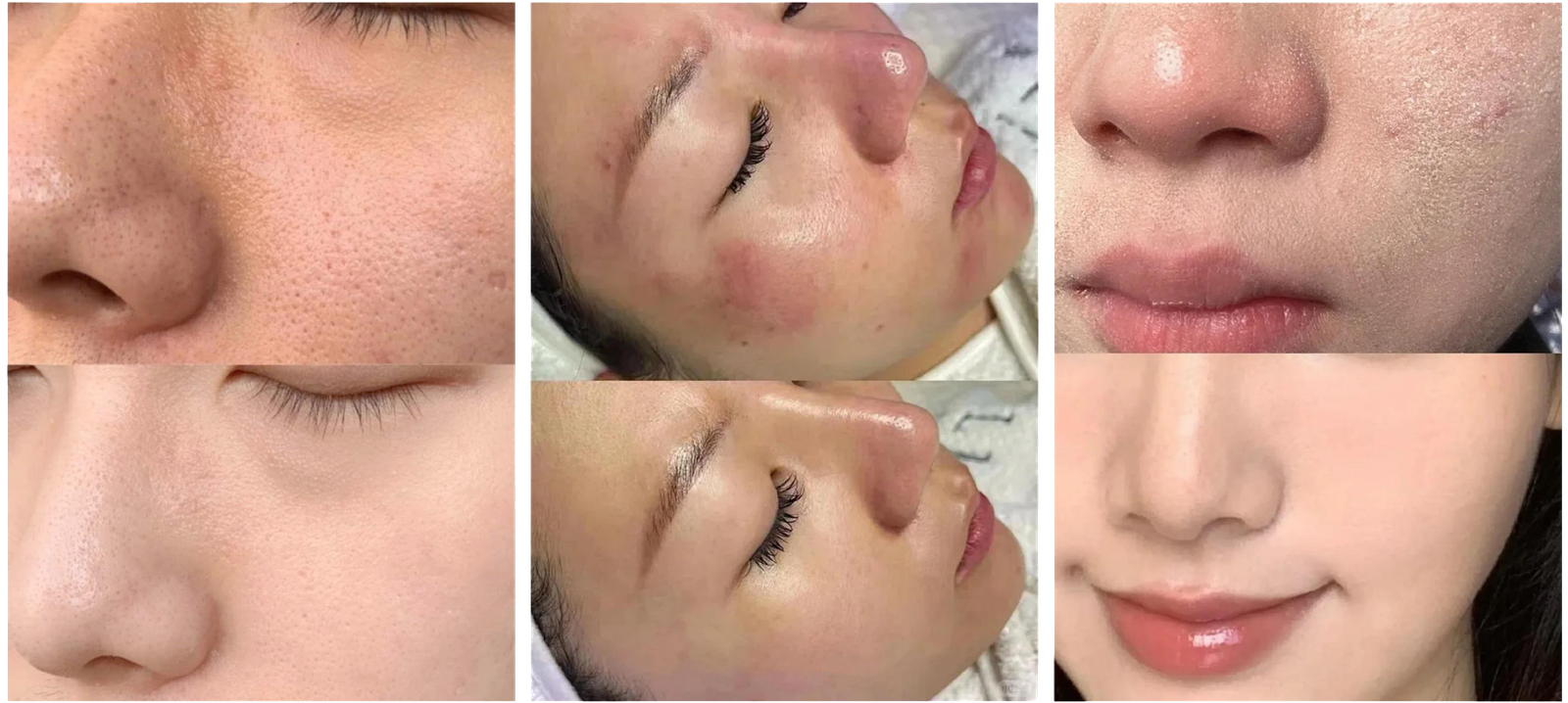 ba-mf27 treatment before after