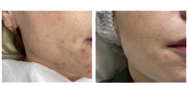 BA-MF28 DPL Laser before after