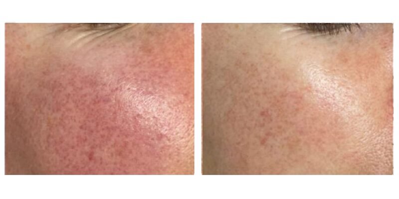 BA-MF28 DPL Laser before after