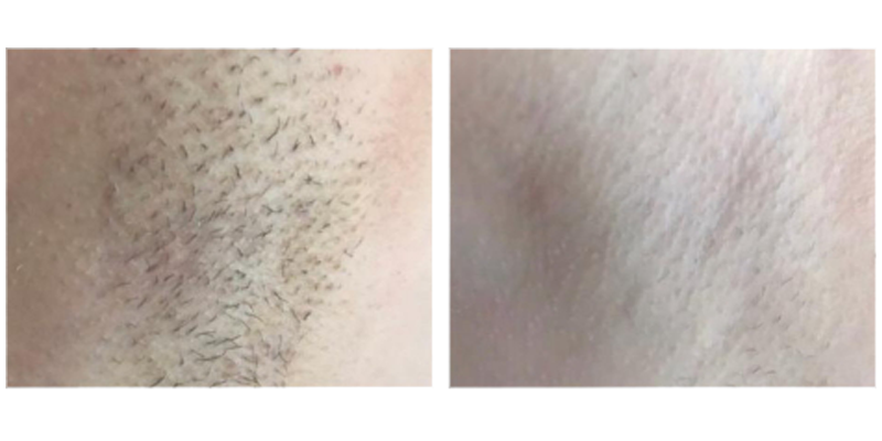 BA-MF28 DPL Laser before after