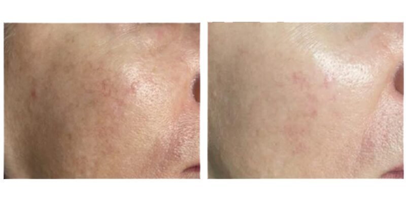 BA-MF28 DPL Laser before after