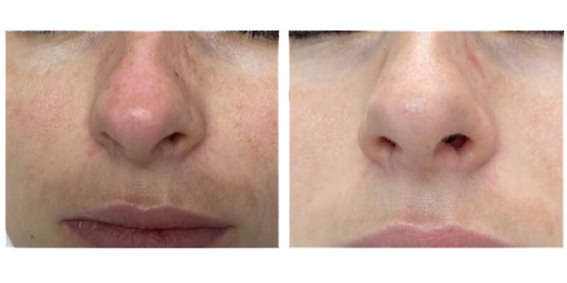 BA-MF28 DPL Laser before after