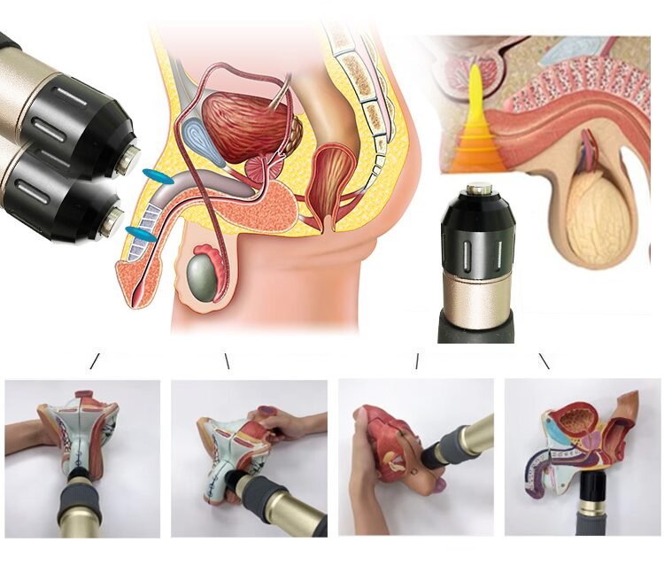 ba-sw36 pneumatic shockwave ed treatment principle