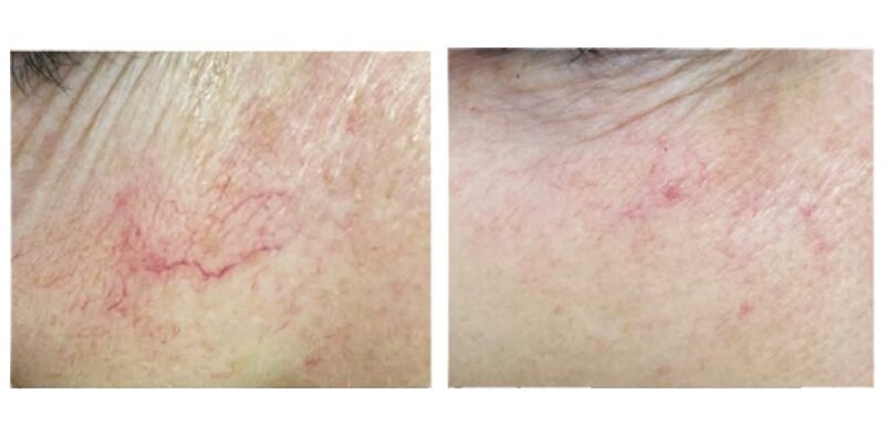 BA-MF28 DPL Laser before after