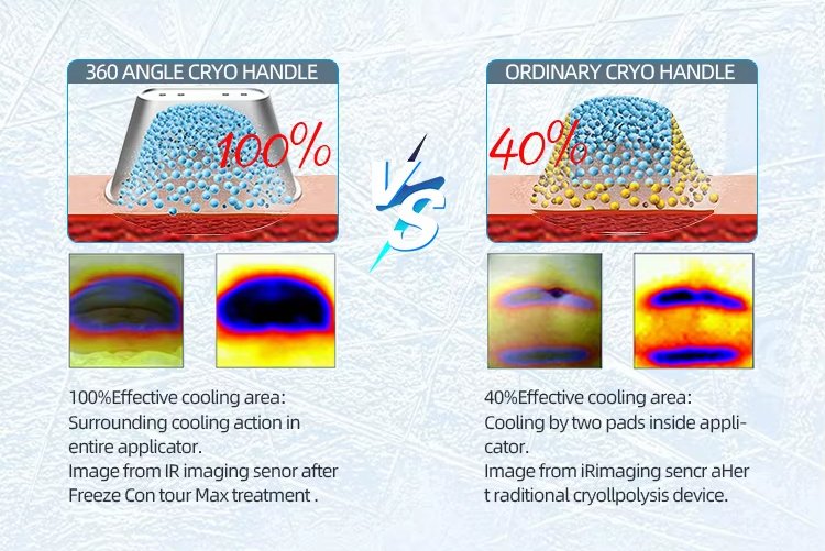 ba-cr23 cryo fat freezing machine principle