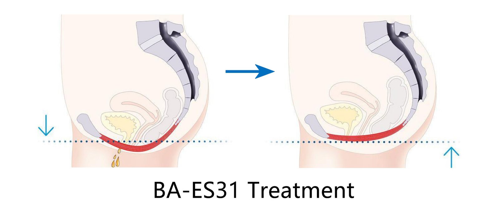 BA-ES31 ems chair principle