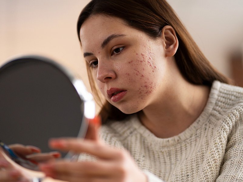 Care for acne and skin inflammation