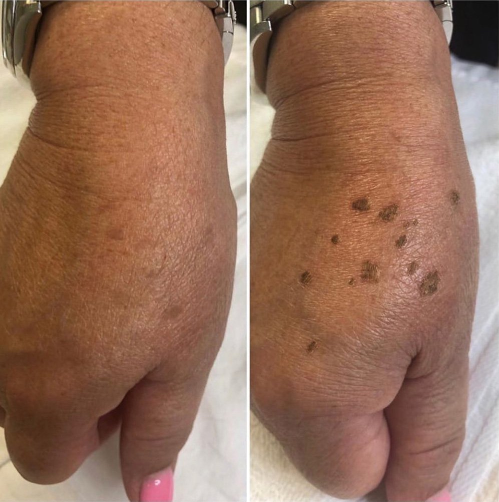 BA-FP21 Fusion Plasma Machine Treatment Before After