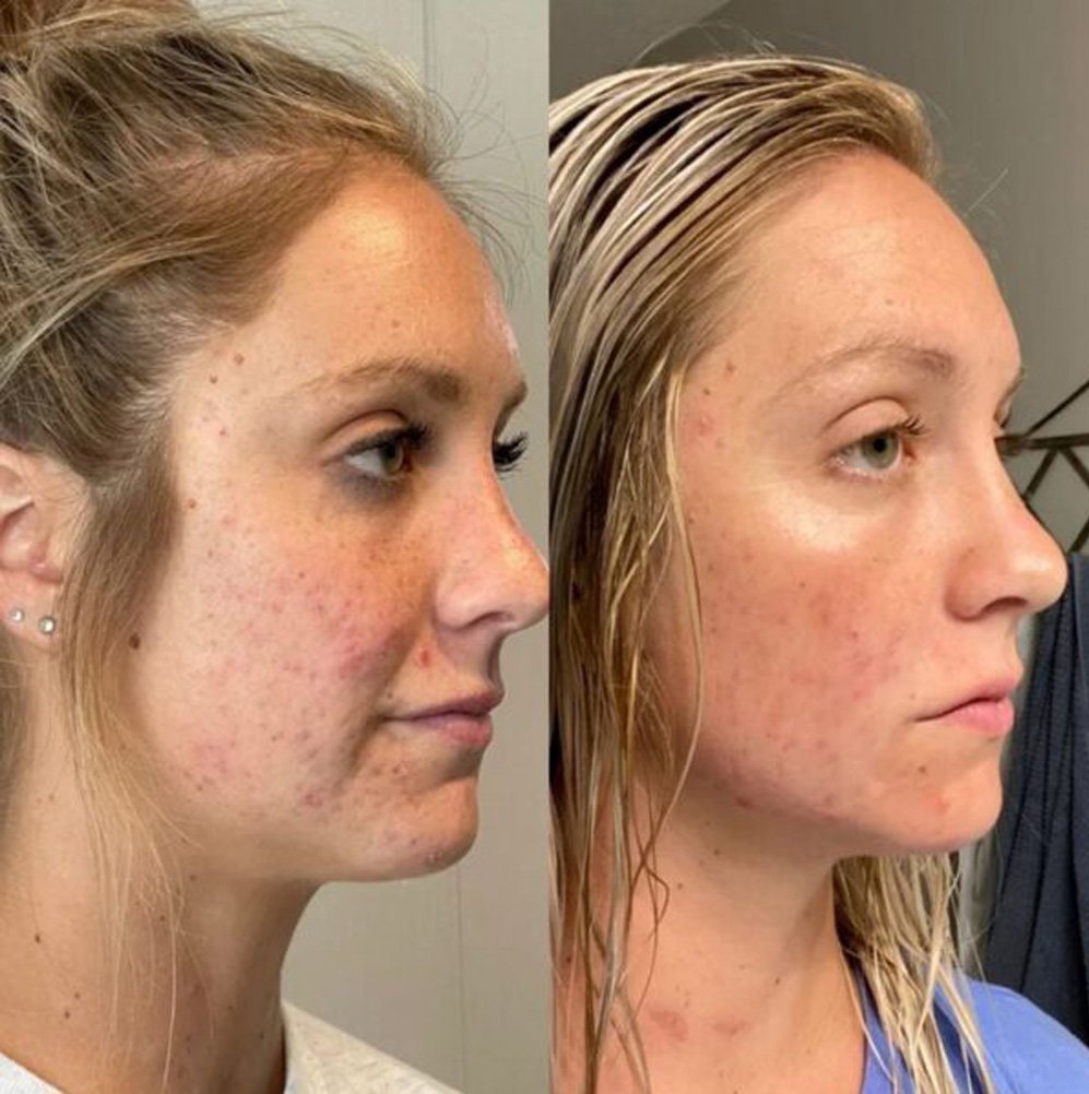 BA-FP21 Fusion Plasma Machine Treatment Before After
