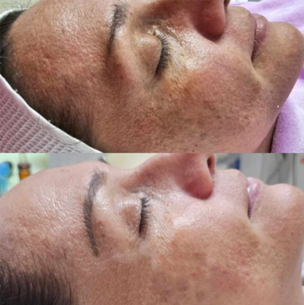 BA-FP21 Fusion Plasma Machine Treatment Before After
