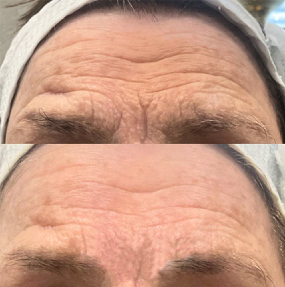 BA-FP21 Fusion Plasma Machine Treatment Before After