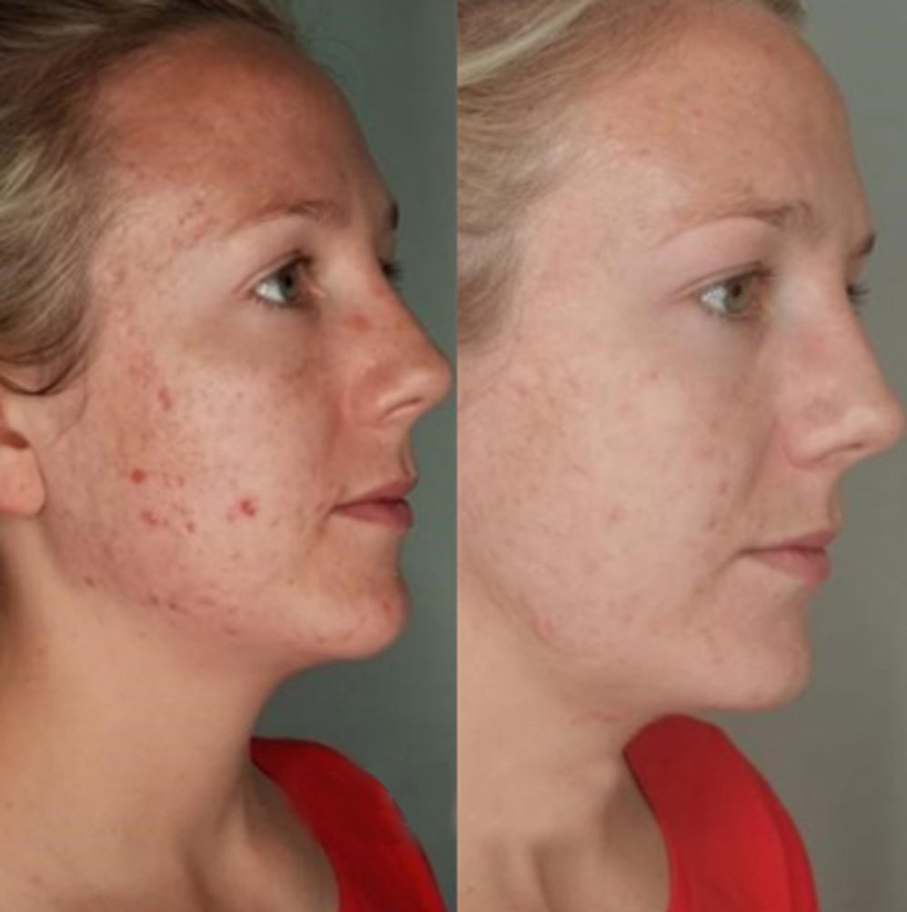 BA-FP21 Fusion Plasma Machine Treatment Before After