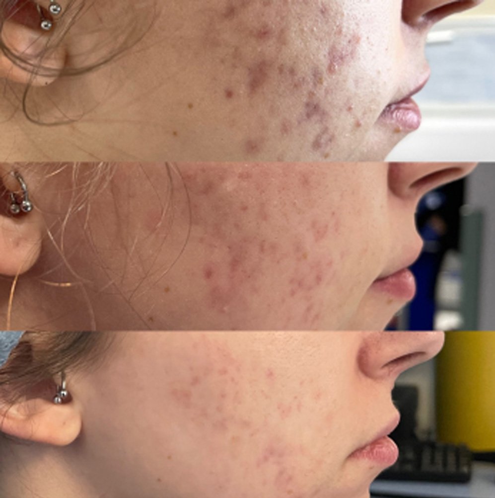 BA-FP21 Fusion Plasma Machine Treatment Before After